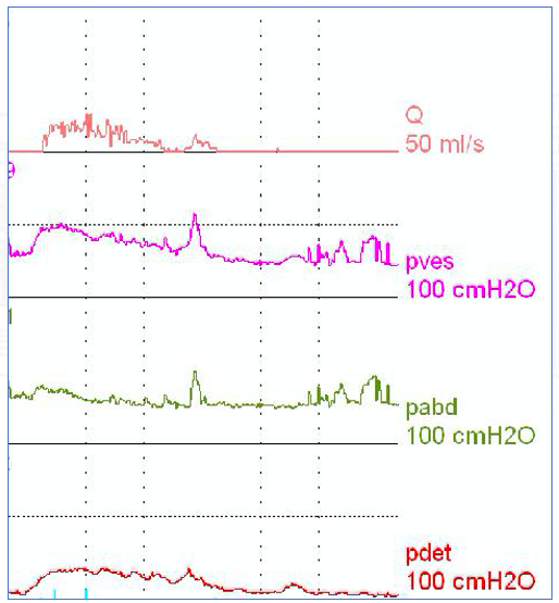 Fig. 9. Estudio urodinámico: Hipoactividad del detrusor