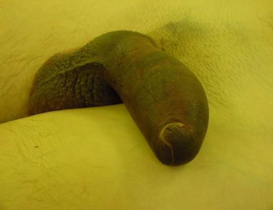 Fig,15. Fractura de Pene