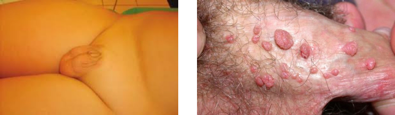 Fig 4. a. Pene sumido. b. Múltiples condilomas genitales