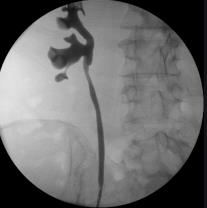 Fig. 12 Pielografia retrograda, llene de aparato caliciliar.