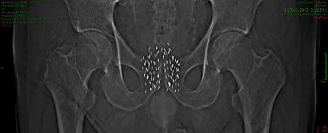 Fig 2. Radiografía mostrando la ubicación de las semillas