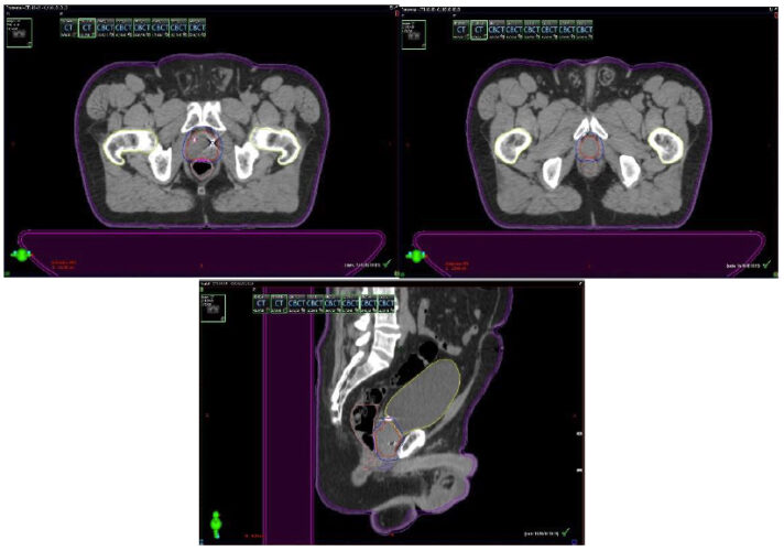 Fig. 6. Tac con fiduciales y contornos. Dosimetria: 36.25Gy en 5 Sesiones, Dias alternos. Los fiduciales,son los puntos blancos dentro de la prostata semilla que se implantan previamente para tener un punto de referencia local confiables al realizar imágenes diaras previo al inicio de cada sesión.