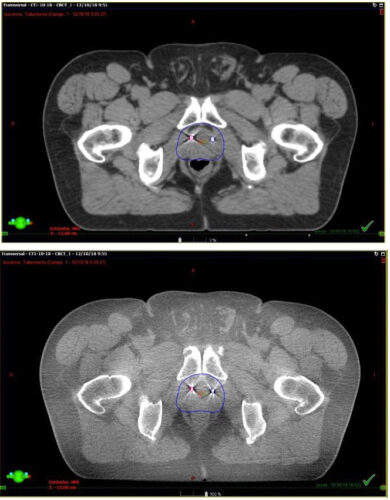 Fig. 8. Paciente en tratamiento. Esta imagen corresponde el conbeam que se realiza en cada sesión de tratamiento y se superpone con el TAC previo de simulación que tiene los contornos. El contorno azul fue realizado previamente en el TAC de simulación. Así sabemos que la dosis llegará sólo sobre ese sector.