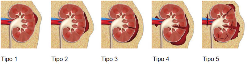 Fig. 2. Esquema de lesiones renales de la AAST.