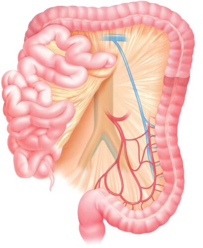 Fig. 3 A. Línea de incisión peritoneal