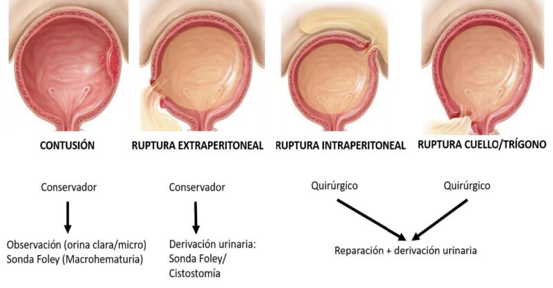 Fig 3. Manejo del traumatismo vesical cerrado