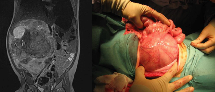 Fig.14. Uro resonancia y aspecto intraoperatorio de un tumor de Wilms derecho