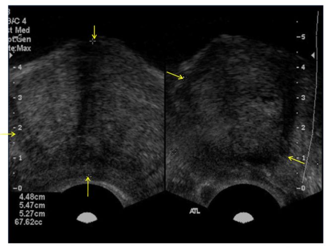 Fig.1. Cortes ecográficos transversal y longitudinal de la glándula prostática, medidas y volumen.