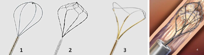 Fig. 16 1. Canastillo de 4 hebras, romo o “tipless” 2. Canastillo tipo “paracaidas” 3. Canastillo de apertura frontal
