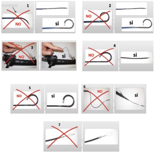 Fig. 26 1: No deflectar el ureteroscopio dentro de la vaina de acceso 2. No retirar el ureteroscopio deflectado contra el borde de la vaina. 3. No insertar una guía de seguridad de punta dura por el canal de trabajo en forma retrógrada. En este caso es necesario utilizar una guía de doble punta flexible. 4. No insertar la fibra del láser holmio cuando el ureteroscopio flexible está deflectado. Siempre insertar la fibra con el ureteroscopio recto. 5. No insertar una fibra de 365 um ya que este diámetro impide una deflexión de 2700. Inserte una de 200 o 270 um. Por otro lado, la fibra de 365 um impide una irrigación adecuada. 6. No doble el cuerpo del ureteroscopio al insertarlo en la vaina ya que puede dañarlo y además no lograr una buena deflexión distal. 7. No utilice canastillos tipo Dormia con punta ya que dañan el ureteroscopio al introducirlos en deflexión. Utilice solo canastillos “tipless” con un diámetro menos de 1,9 Fr.