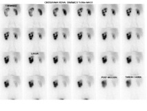 Fig. 9. Imágenes seriadas en obstrucción pielo-ureteral izquierda (proyección posterior).