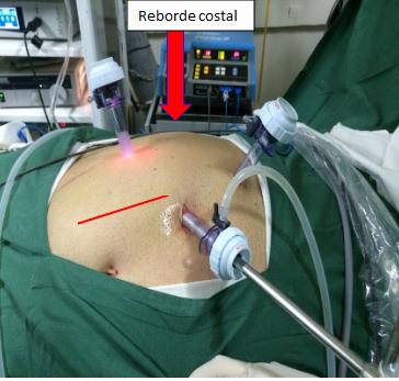 Fig. 11a. Posición sugerida de trocares para cirugía transperitoneal.