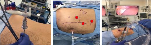 Fig. 11b. Posición sugerida de trocares para cirugía transperitoneal.