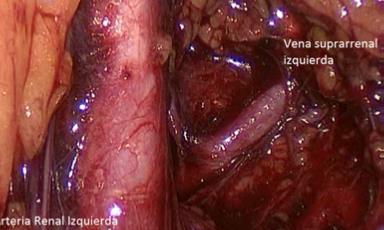Fig. 18. Identificación de vena suprarrenal izquierda por vía retroperitoneal.