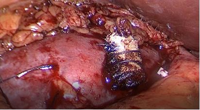 Fig. 27. Puntos hemostáticos con rollo de SurgicelR.