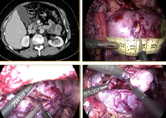 Fig. 29. Técnica de nefrectomía parcial en tumor intrarrenal