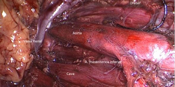Fig. 31. Visualización de linfadenectomía retroperitoneal izquierda, después de la extracción de espécimen quirúrgico.