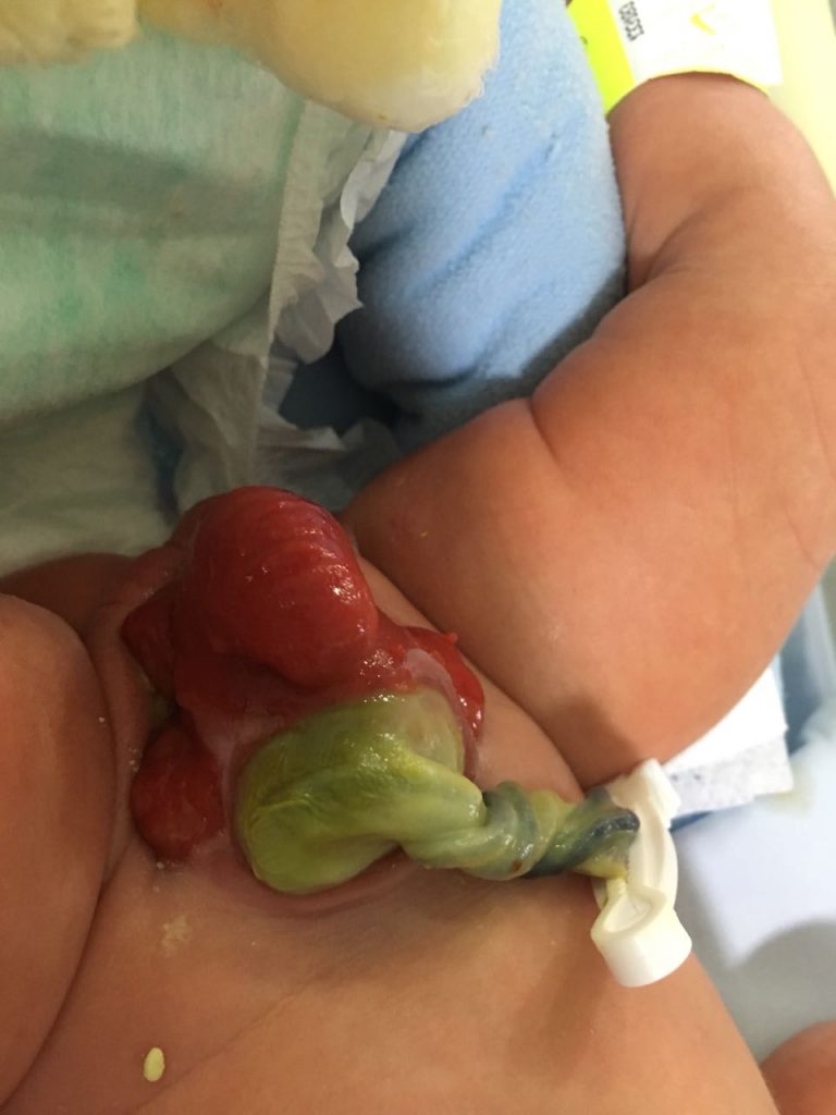 Fig. 4. Variante extrofia vesical