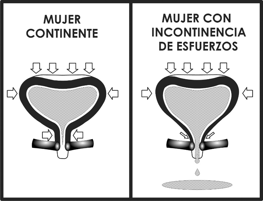 Fig. 1. Teoría de transmisión de presiones de Enhorning.