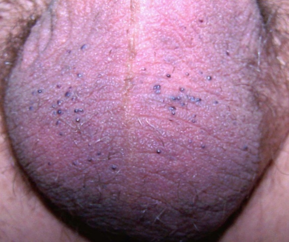 Fig,17. Angioqueratomas escrotales