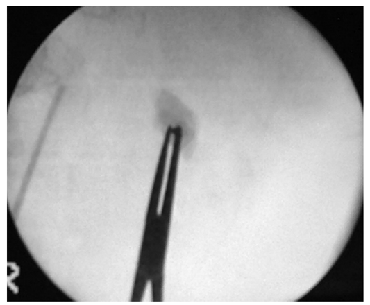 Fig.5 Técnica Ojo de buey