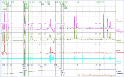 Fig. 6. Incontinencia de orina de esfuerzo documentado en estudio urodinámico