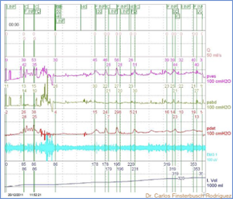 Fig. 7. Estudio urodinámico: Hiperactividad fásica del detrusor.
