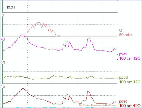 Fig. 8. Estudio urodinámico: Hiperactividad terminal del detrusor.