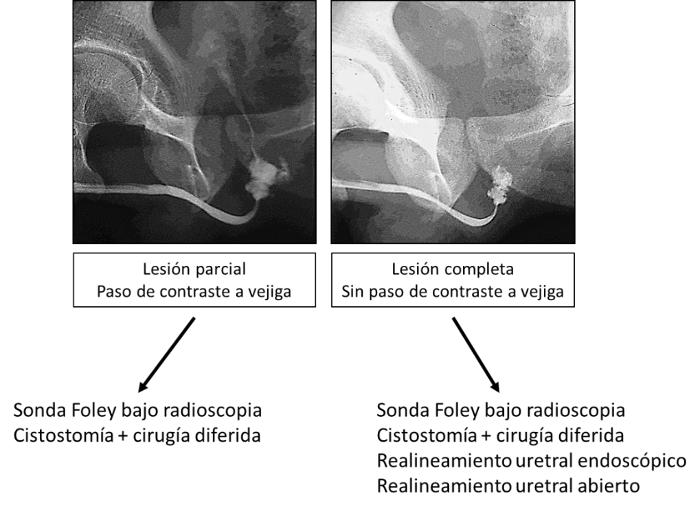 Fig 4. Manejo inicial del traumatismo uretral