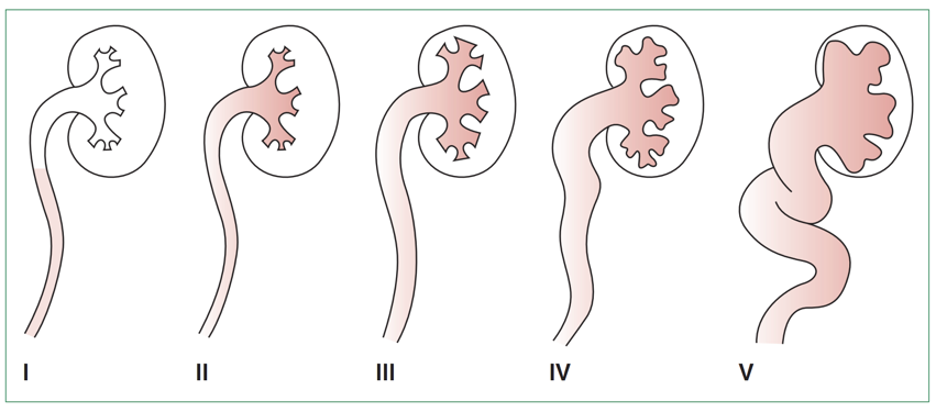 Fig. 11. Clasificación del reflujo por UCG (Tullus, 2014)
