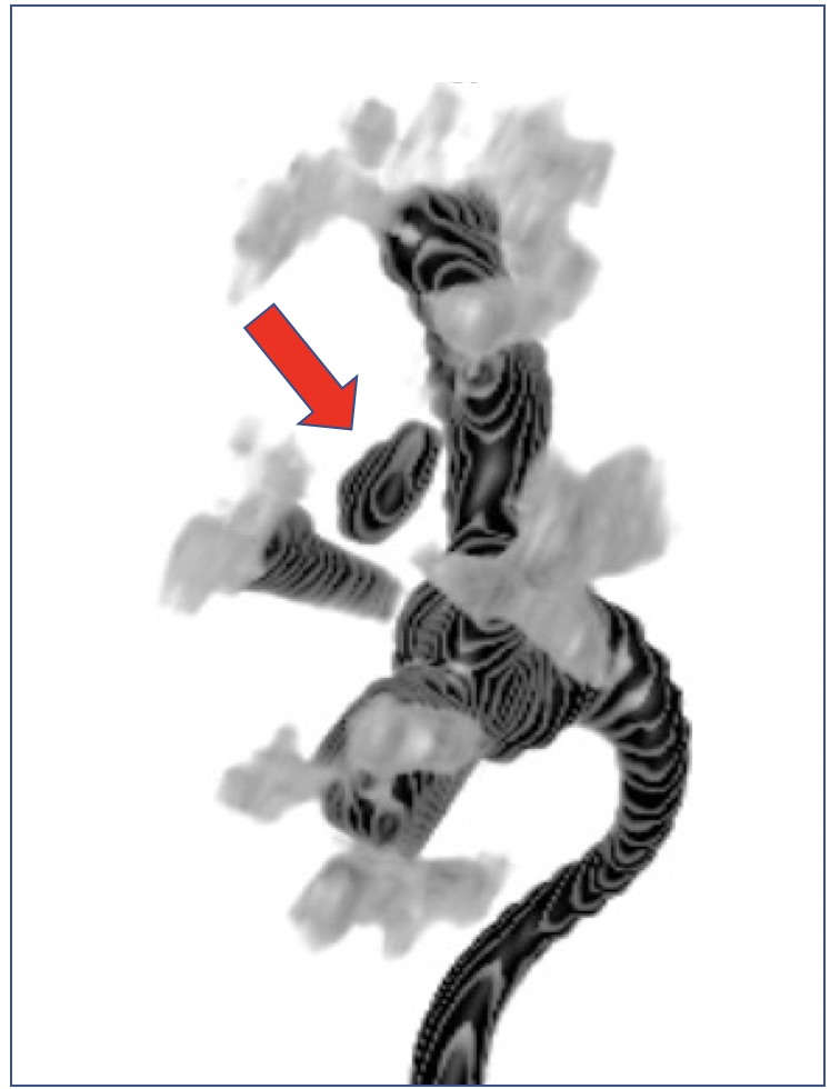 Fig. 7 Imagen 3D de Scanner renal con medio de contraste. La flecha roja muestra litiasis renal. Historia clínica: Paciente con litiasis renal de 1 cm de diámetro diagnosticada con ecografía abdominal. Se realiza scanner sin medio de contraste informándose litiasis de cáliz medio de 1300 UH y antecedentes de cólico renal previo. En la RIRS no se logró acceder a dicho cáliz a pesar de realizar pielografía retrógrada y prueba de Indigo Carmin: RIRS en blanco.