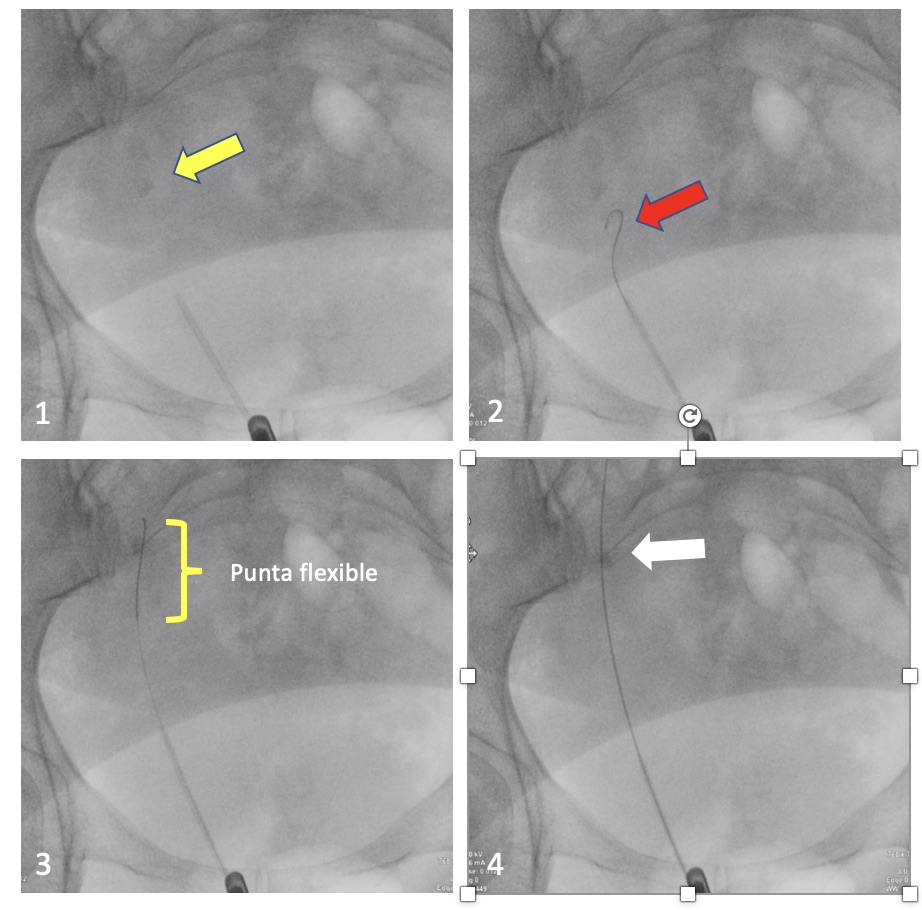 Fig. 11 Secuencia de instalación de Guía de seguridad de cuerpo rígido y punta flexible: 1.Cateter ureteral a distal a litiasis (flecha amarilla) 2. Punta flexible negociando pasada a proximal (flecha roja) 3. Punta flexible 4. Litiasis ureteral sobrepasada por guía de seguridad.