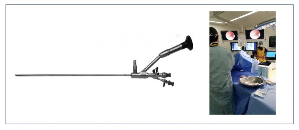 Fig. 14 Ureteroscopio semirrígido e imagen endoscópica de ureterolitectomía semirrígida