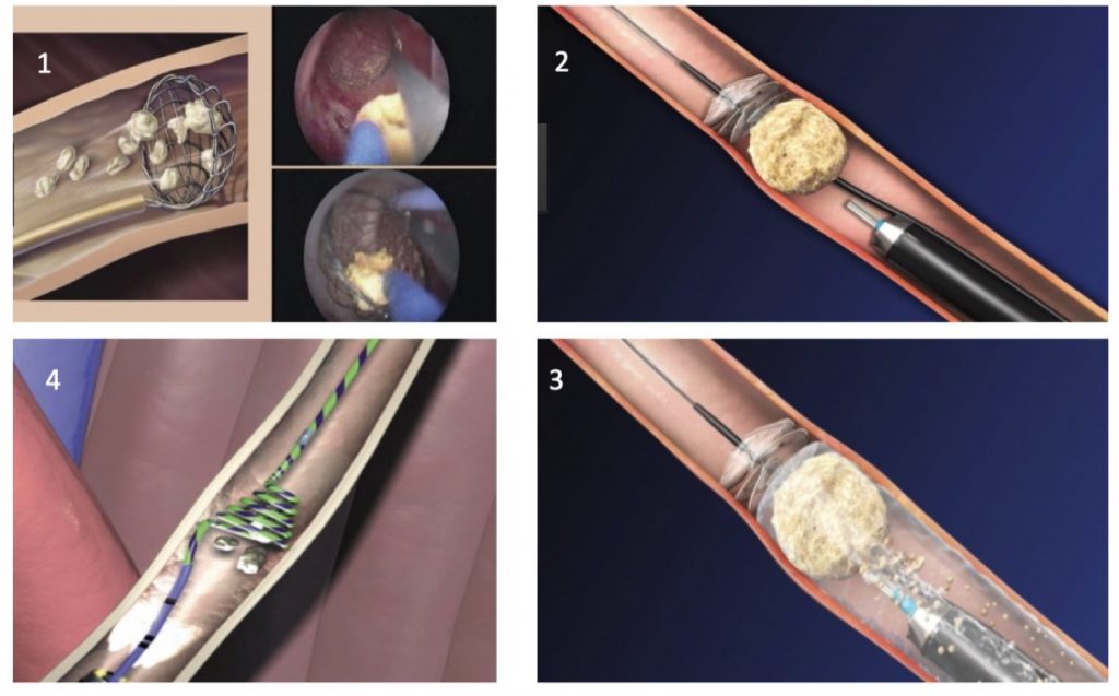 Fig. 17. Dispositivos anti migratorios de fragmentos de litiasis ureterales durante litotripsia endoscópica.