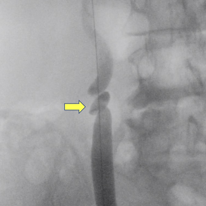 Fig. 22: La flecha amarilla indica la Acodadura ureteral demostrada con una pielografía ascendente.
