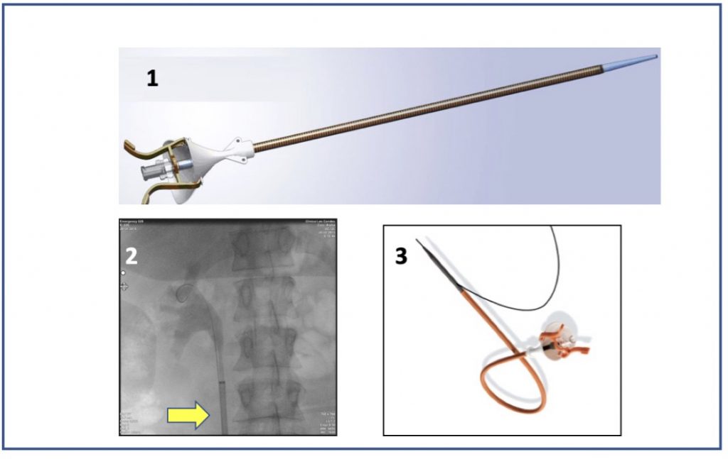 Fig. 24 1. Vaina de acceso ureteral 2. Visión radioscópica intraoperatoria de vaina sin el conductor. 3. Vaina de acceso que se instala con una sola guía y que queda como guía de seguridad.