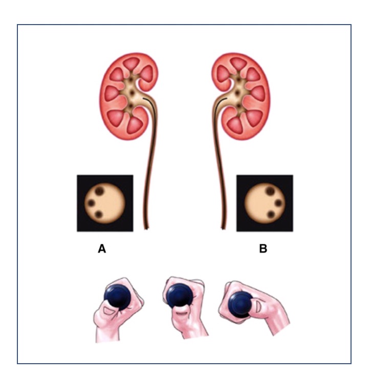 Fig. 27 Al explorar el riñón derecho (A), los cálices se ven a la izquierda de la pantalla y la muñeca derecha que sujeta el ureteroscopio debe estar girada en supinación. Al explorar el riñón izquierdo (B) los cálices se ven a la derecha de la pantalla y la mano rotará en pronación.