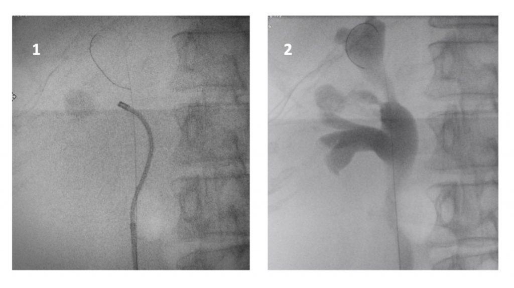 Fig. 29 Pielografía ascendente para individualizar el infundíbulo que corresponde al cáliz donde se encuentra la litiasis.