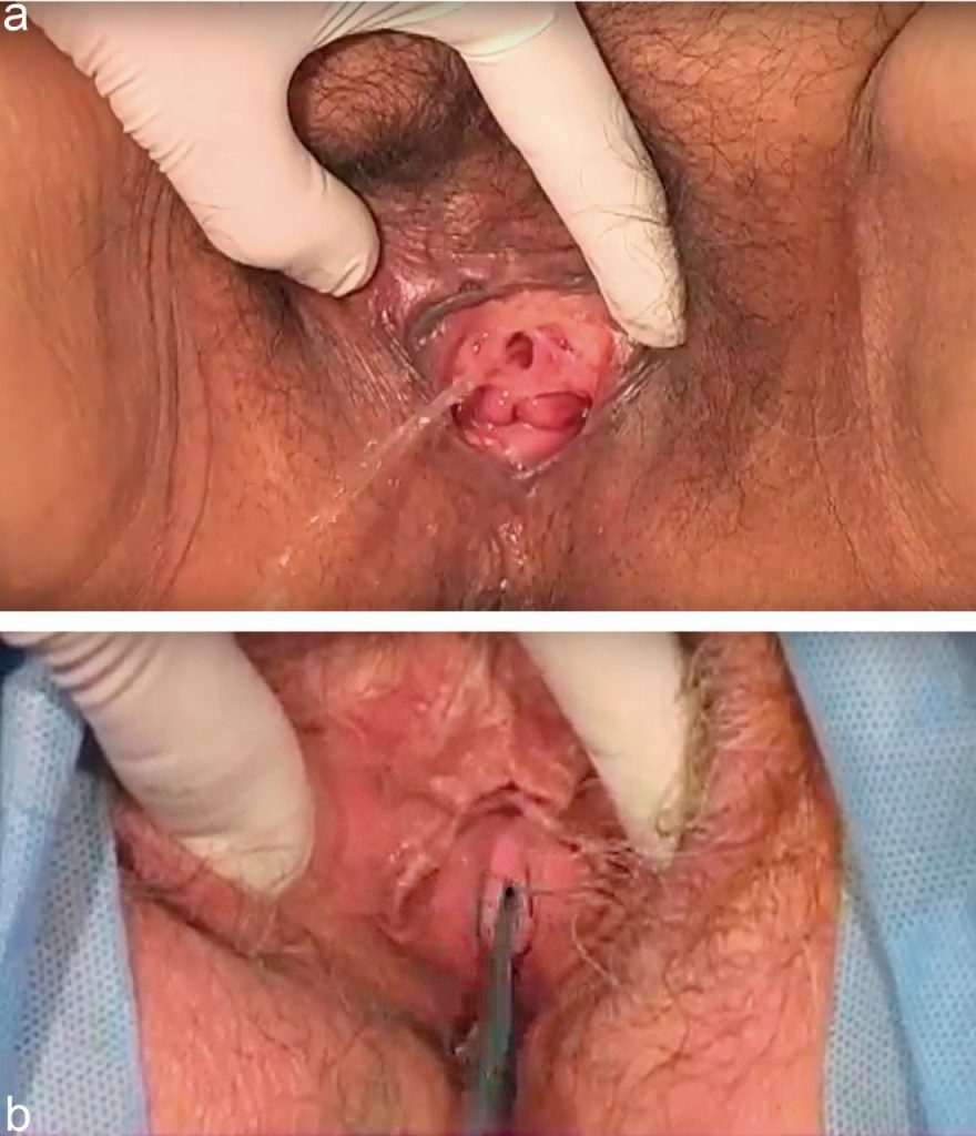Fig. 2. Examen físico de mujeres con IOE. a) test de tos o esfuerzo con vejiga a capacidad 300ml b) Test de esfuerzo con azul de metileno