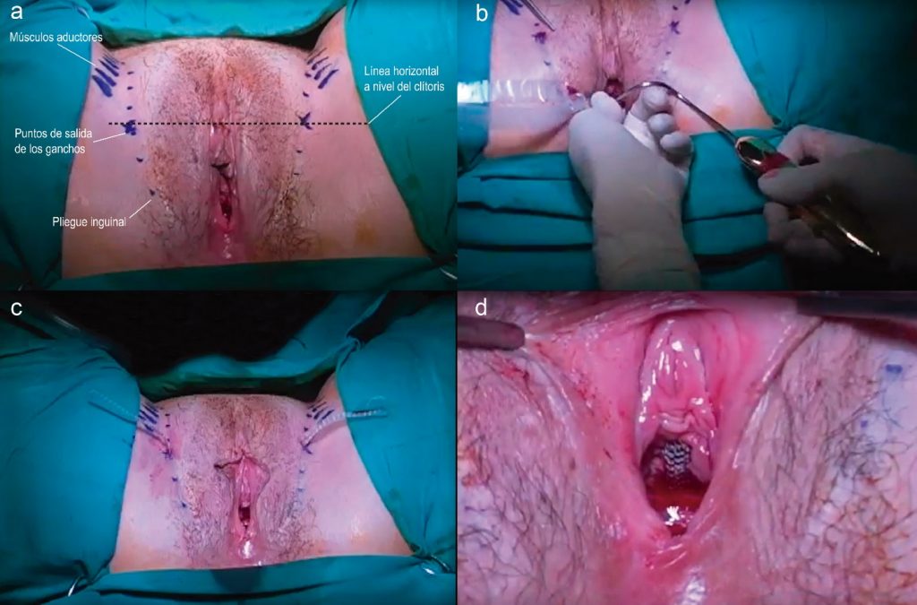 Fig. 3. Cirugía de cinta sub uretral trans obturadora con técnica de vagina a piel o inside out. a) Referencias Anatómicas. b) Paso del gancho helicoidal desde la incisión vaginal hacia el agujero obturador izquierdo de la paciente. c) Malla atravesando ambos agujeros obturadores previo al recorte de excedentes. d)Posición final del segmento sub uretra media posterior al ajuste de tensión de la malla.