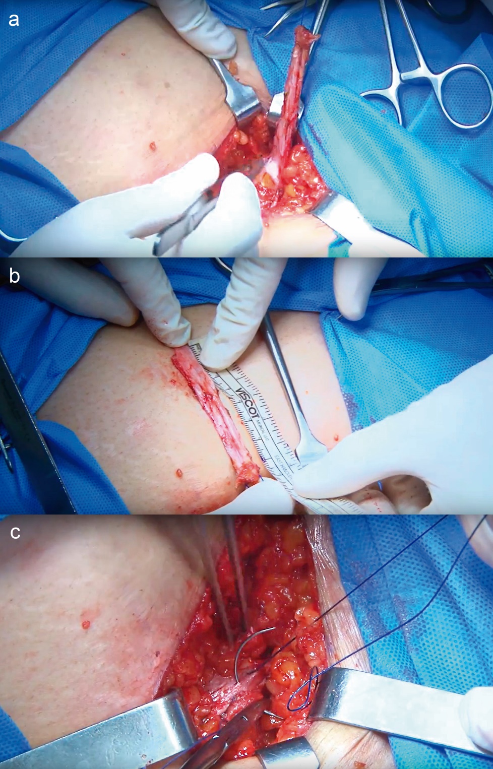 Fig. 5a Principales tiempos quirúrgicos de un Sling de Fascia de Músculos Rectos del abdomen.