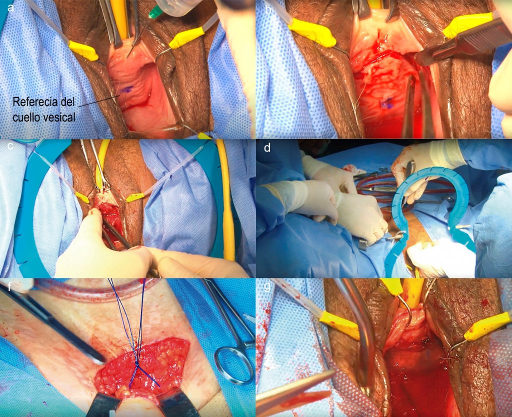 Fig. 5b Principales tiempos quirúrgicos de un Sling de Fascia de Músculos Rectos del abdomen.