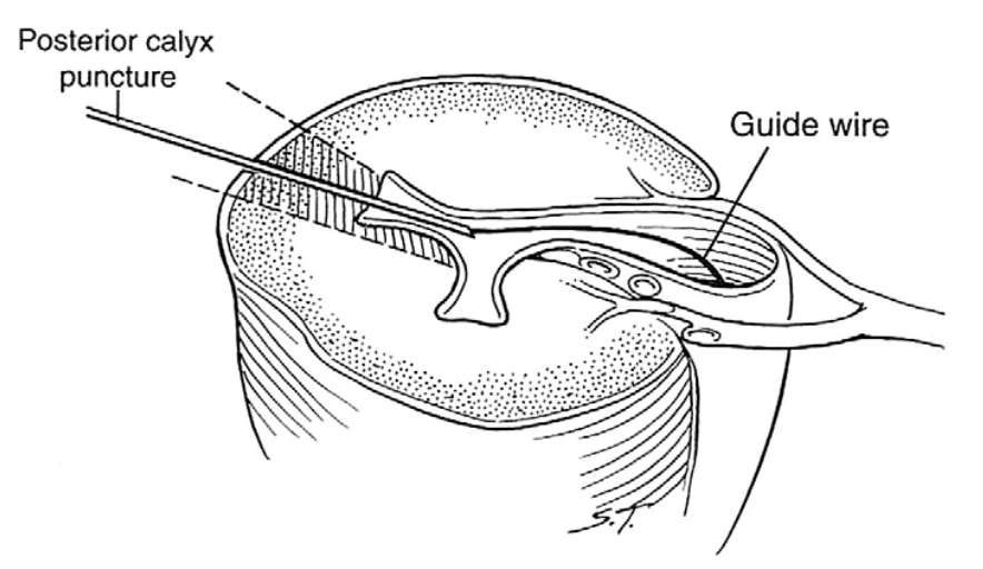 Fig. 3 Punción Transpapilar