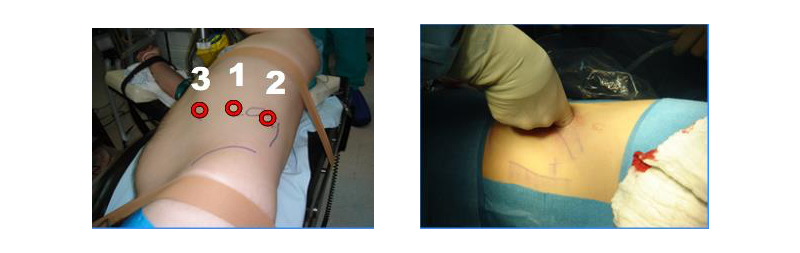 Fig. 13. Puntos de inserción de trócares para abordaje retroperitoneal.