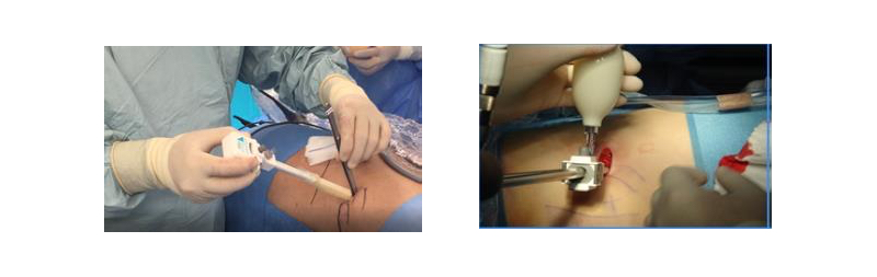 Fig. 14. Balón disector del retroperitoneo. (Spacemaker™ Structural Balloon Trocar, Covidien)