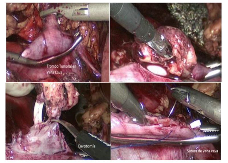 Fig. 23. Trombectomía laparoscópica en trombo tumoral nivel II.