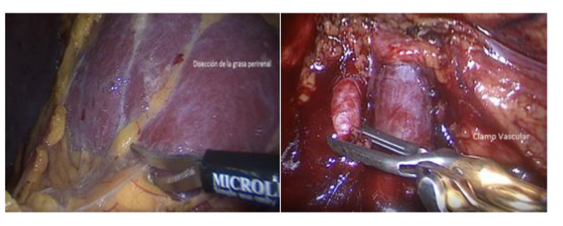 Fig. 25. Disección renal, hasta identificar Hilio renal para su clampeo.