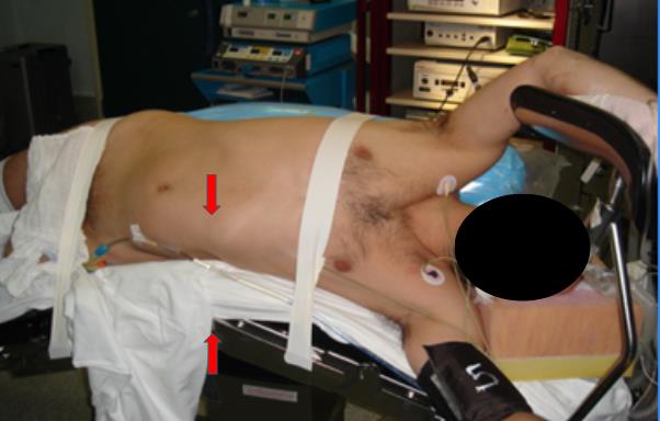 Fig. 3 Línea de quiebre de la mesa en reborde costal