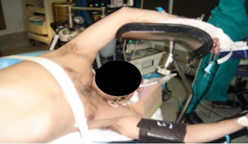 Fig. 6. Posición de “clavado o piquero”