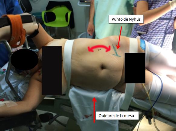 Fig. 7. Demarcación Punto de Nyhus y se pone en evidencia mayor separación costo ilíaca.